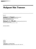 Malignant Skin Tumours